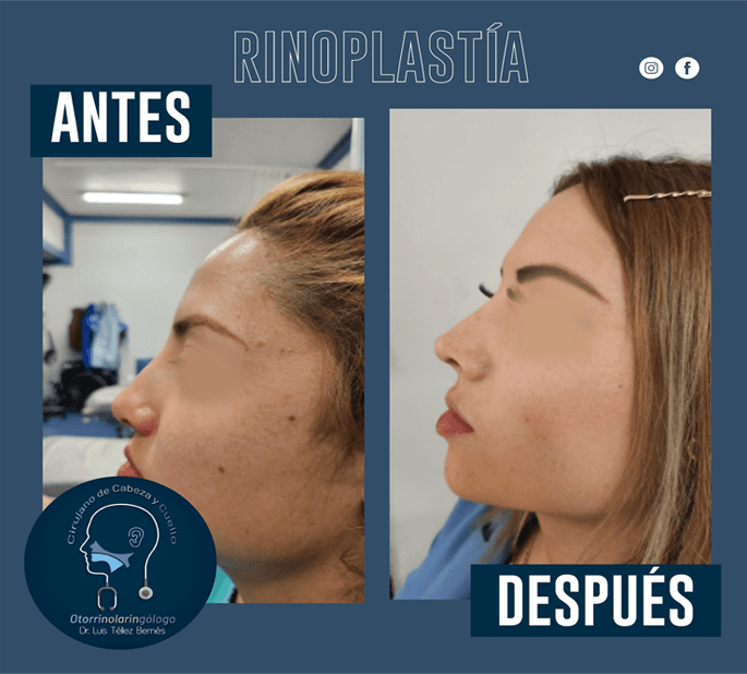 Rinoplastia